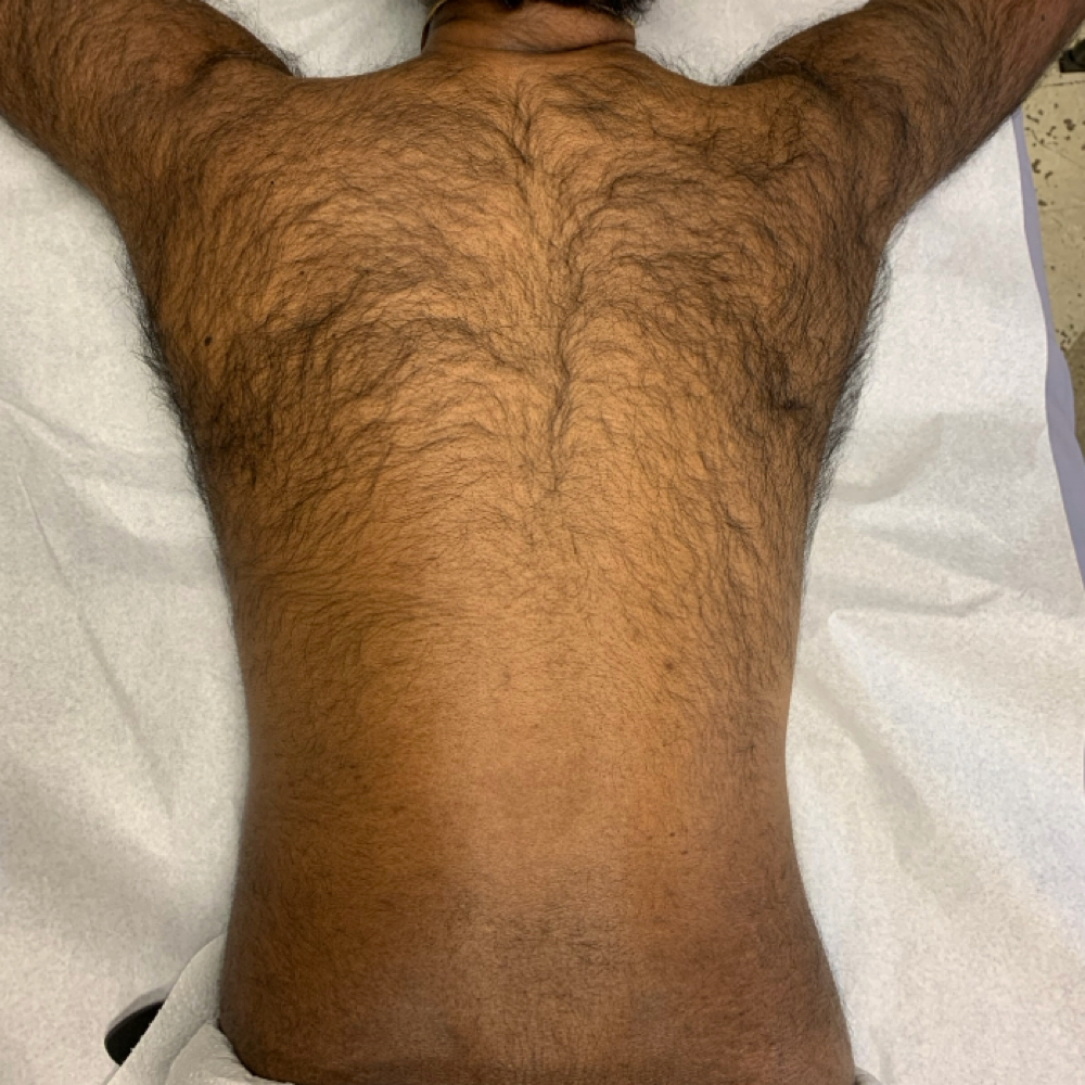 Back Waxing at Poshii GOAT Esthetics in Carmel, IN