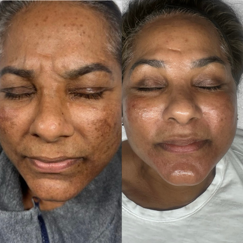 Chemical Peels: Tier Three at Chrome Skin and Beauty in Tamarac, FL