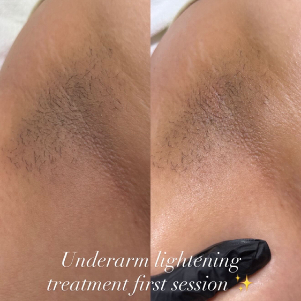 Underarm Lightening at House of Esthetics LLC in Casa Grande, AZ