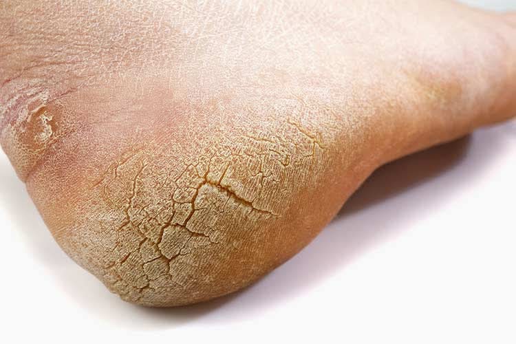 Crack Heel Removal (1 Foot)