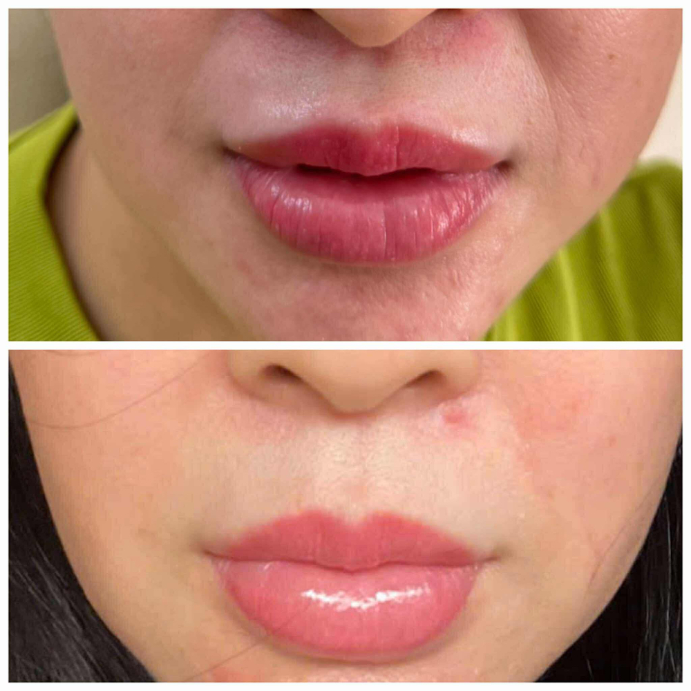 Lip Plasma