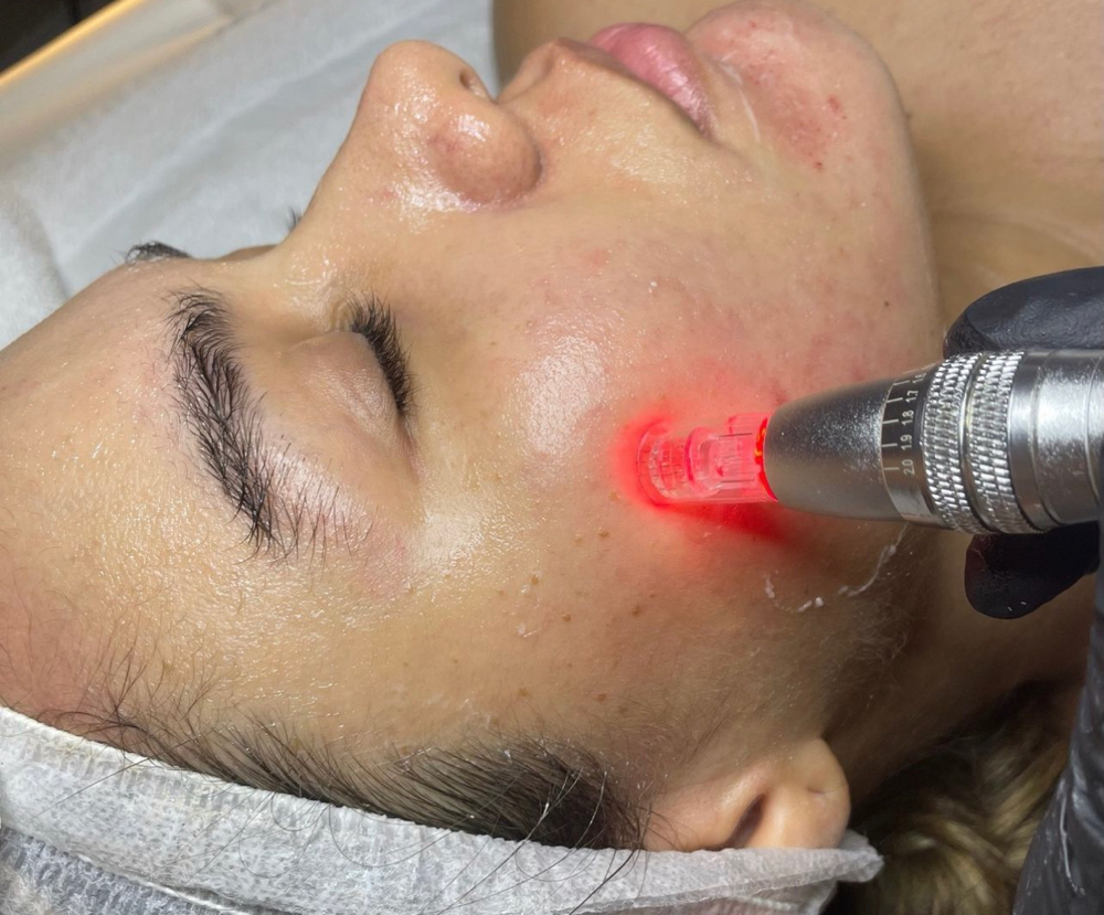 MICRONEEDLING