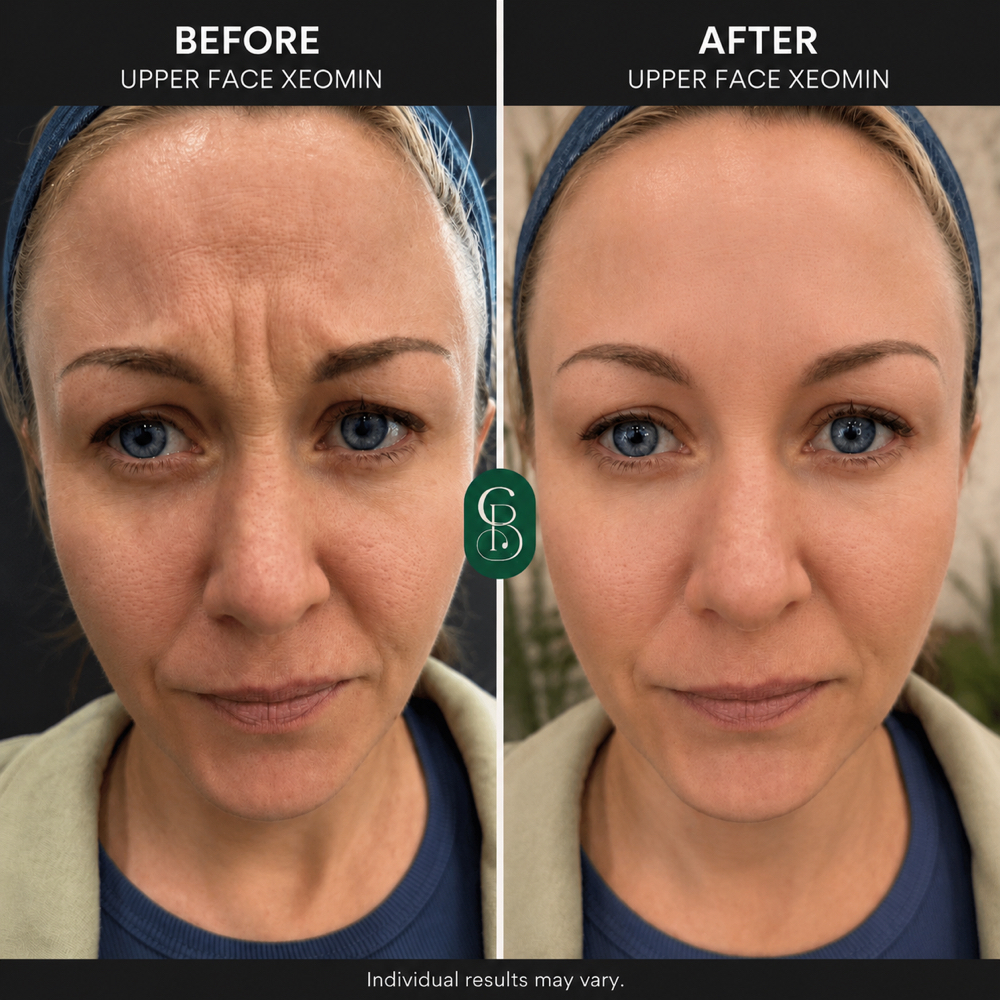 Botox/Xeomin at Chacing Beauty in Dayton, OH