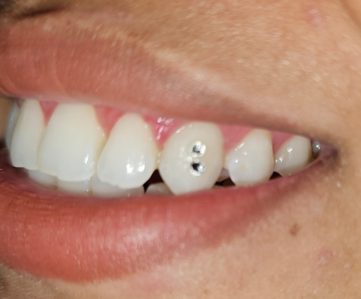 💎 CLASSIC GEM(S)- Wed Appt. Only at Everyday Smiles in san jose, CA