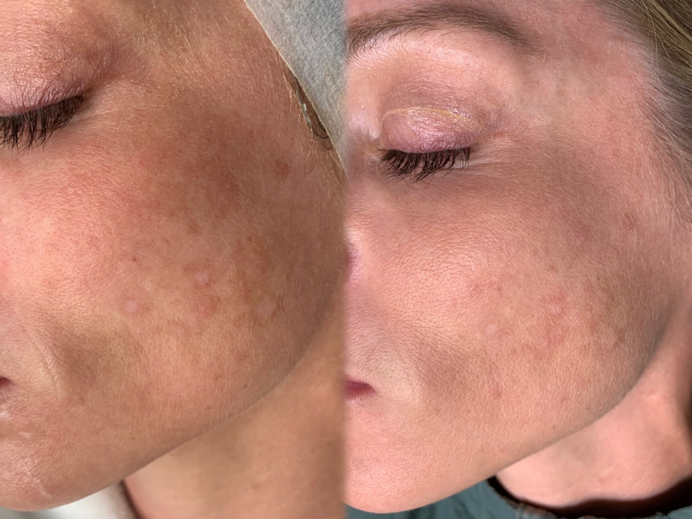 Microneedling With A Chemical Peel