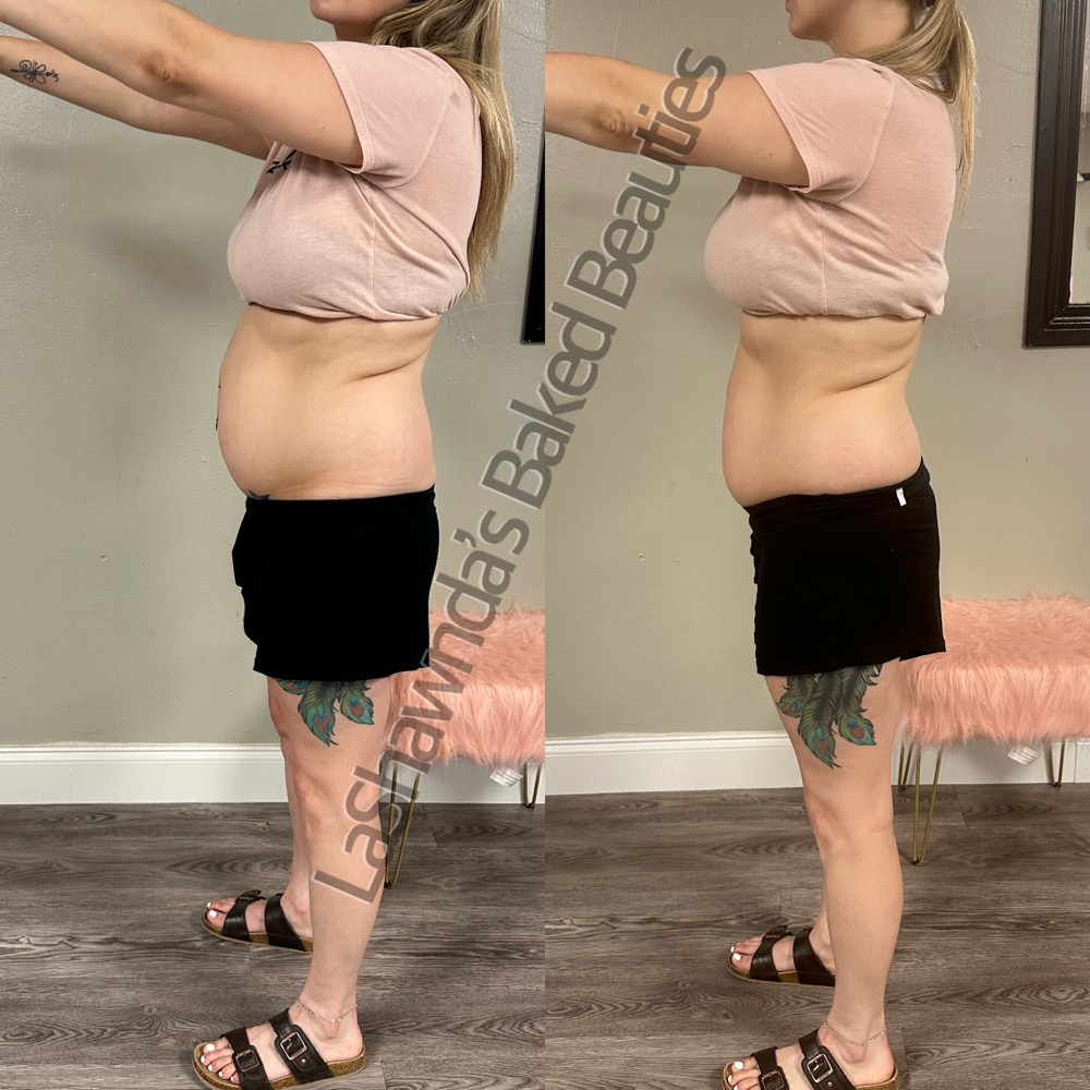 Body Contouring