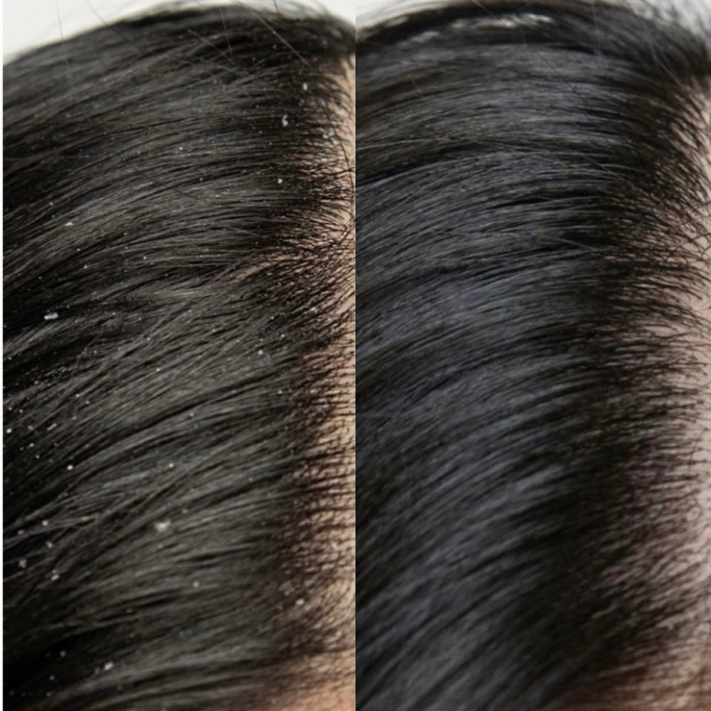 Scalp Exfoliation