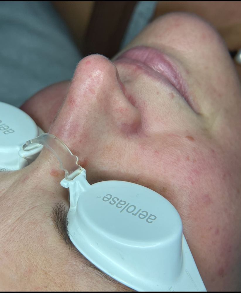 Facial Vein Laser Treatment