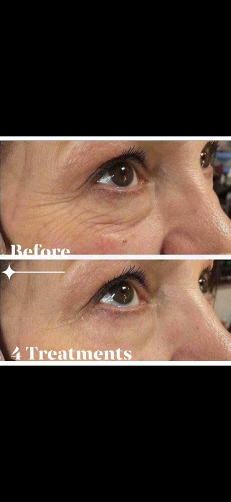 4 Session Procell With After Care