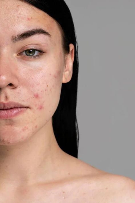 Acne Facial
