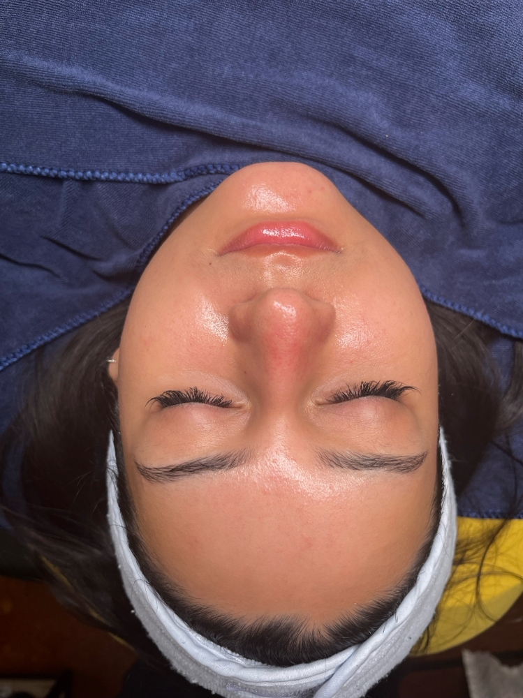 Diamond Microdermabrasion