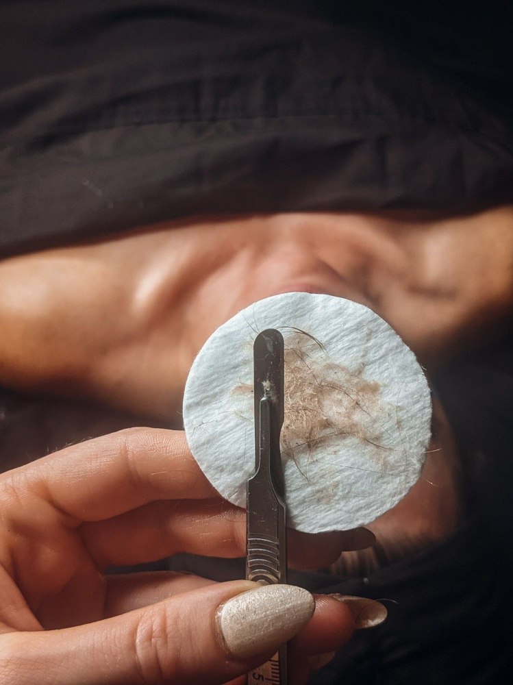 Dermaplaning