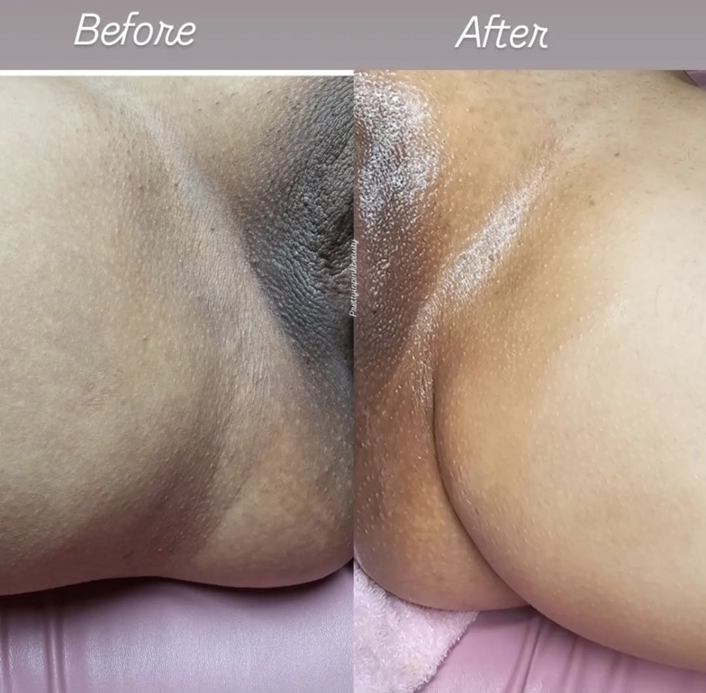 Brazilian Skin Lightening