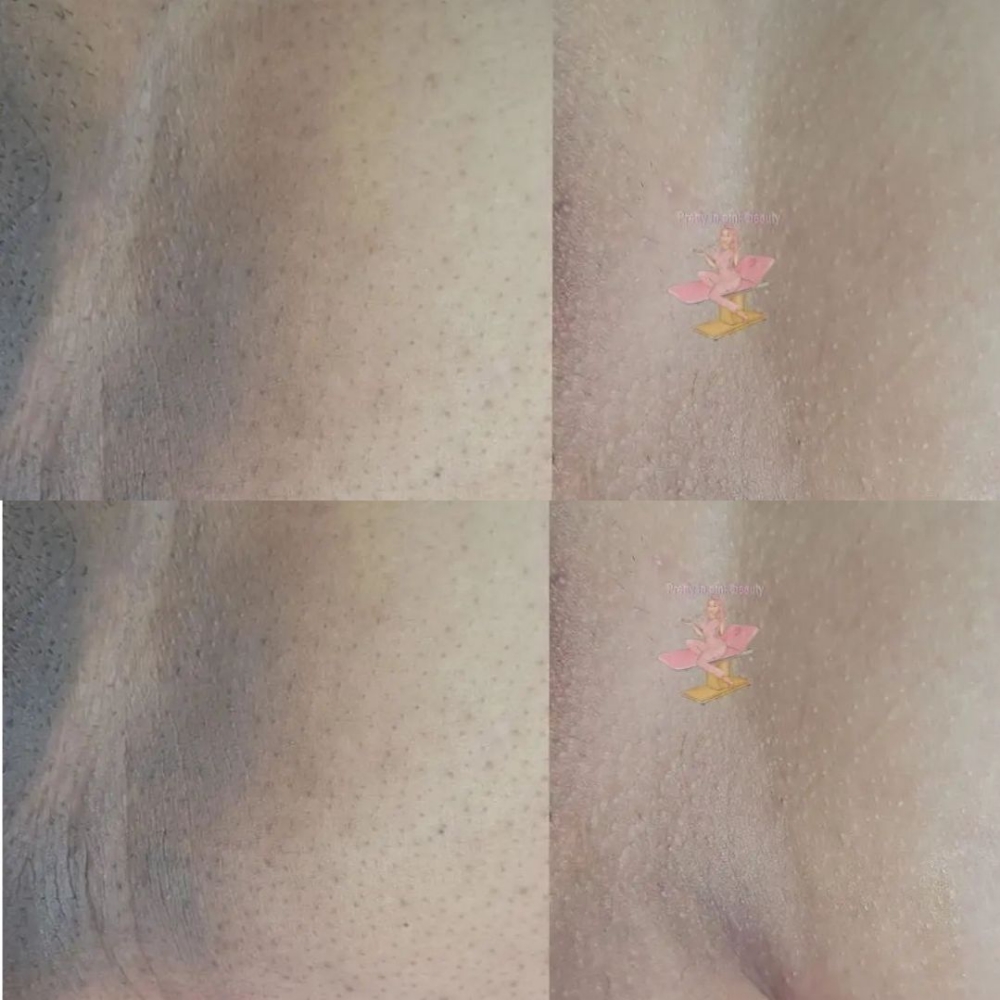 Brazilian Skin Lightening