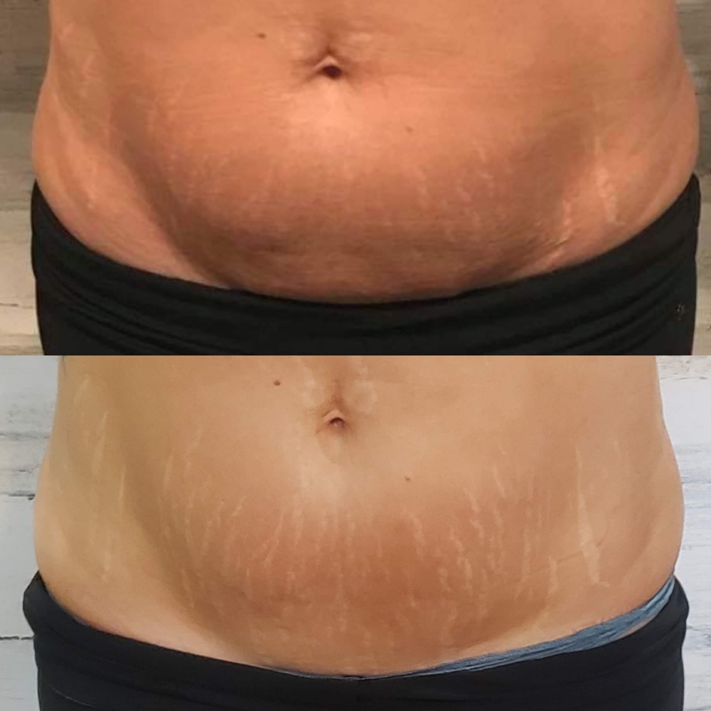 Fat Reduction Single Session