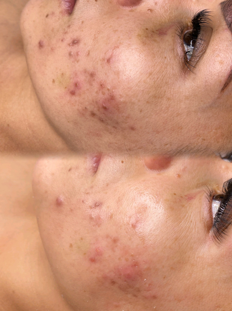 Dermaplaning Facial