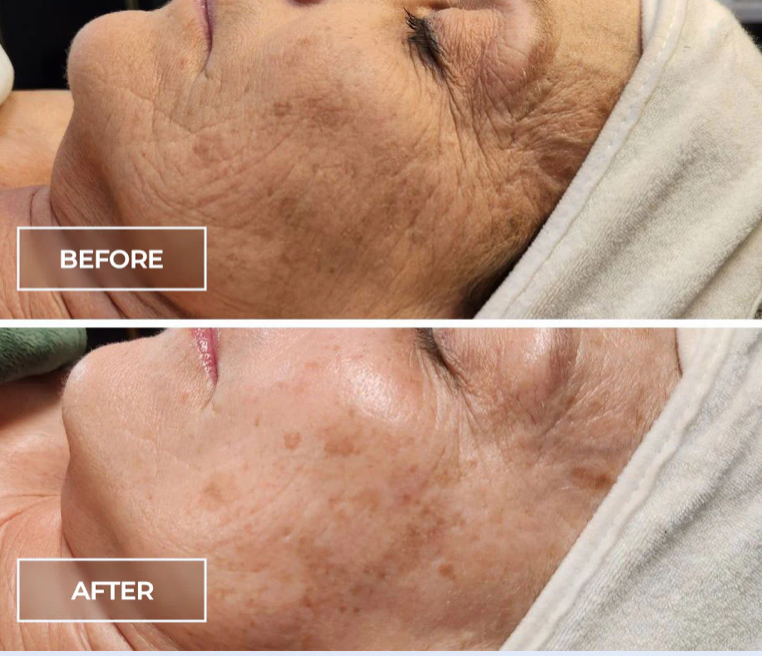SWiCH Facial at Ataraxia Esthetics in Kilgore, TX