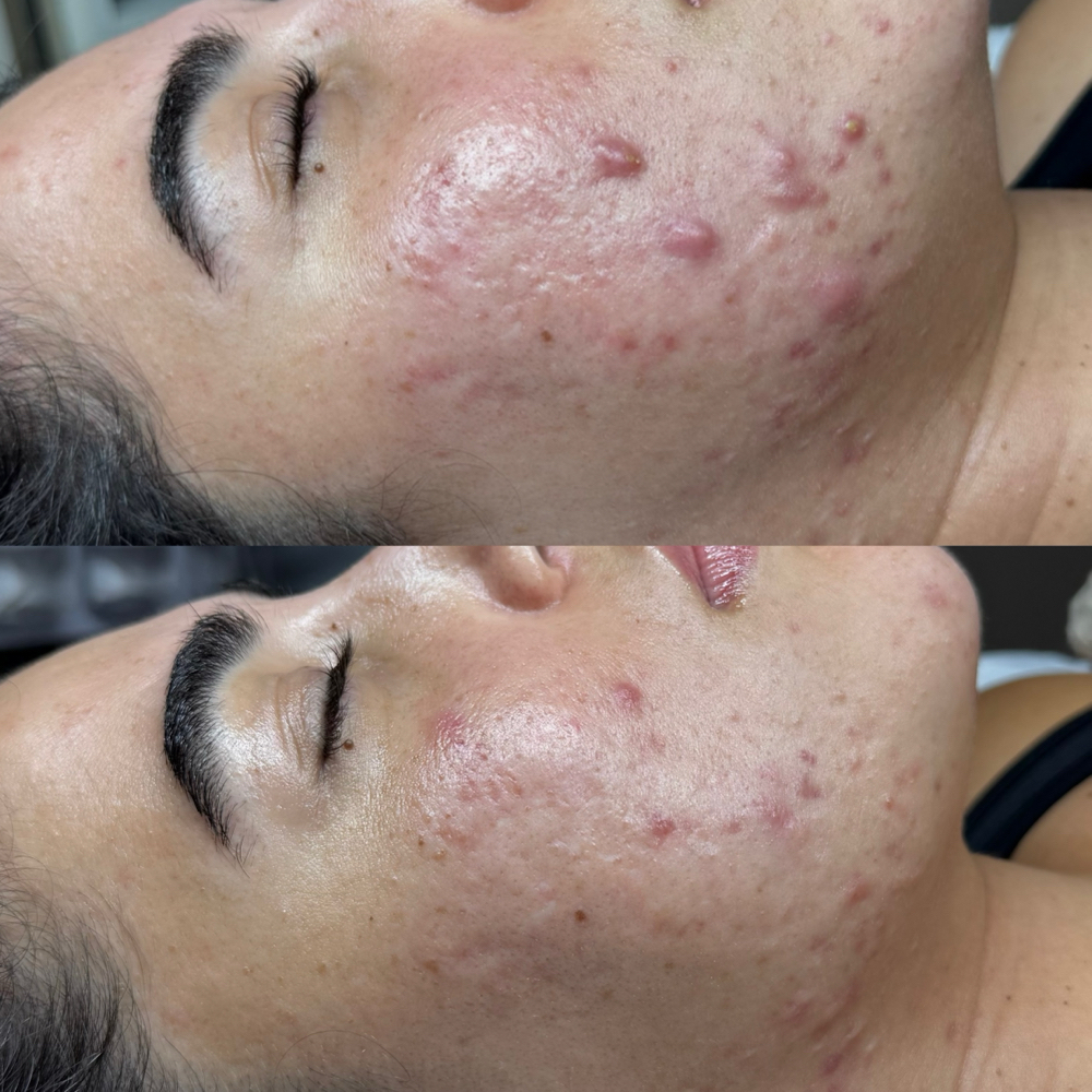 Acne Treatment at Taiane Alvarenga Concept in Woburn, MA