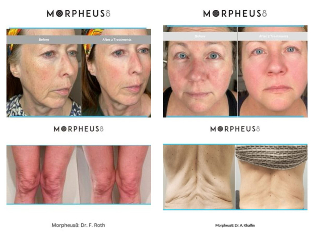 Morpheus8 Treatments