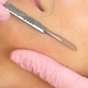 Dermaplaning at Shine Injectable Lounge in Durant, OK