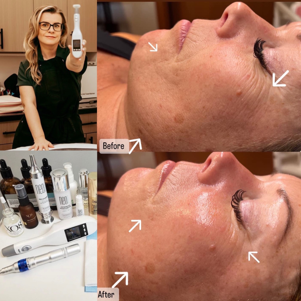 Jet Plasma Revitalization Facial