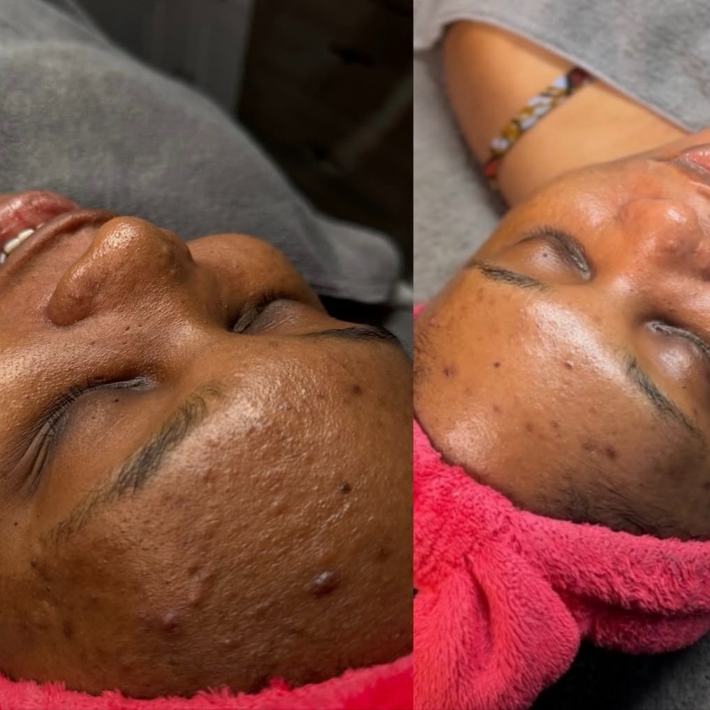 ACNE BOOTCAMP (CLEAR SKIN PROGRAM) at Blanche’s Beautiquè in Charlotte, NC