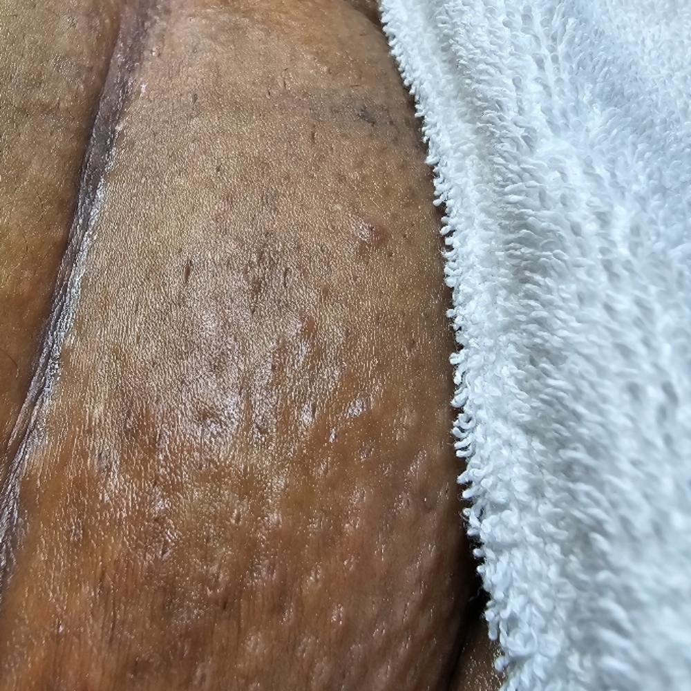 Mons Pubis Renewal at Haus Of Skin in Burleson, TX