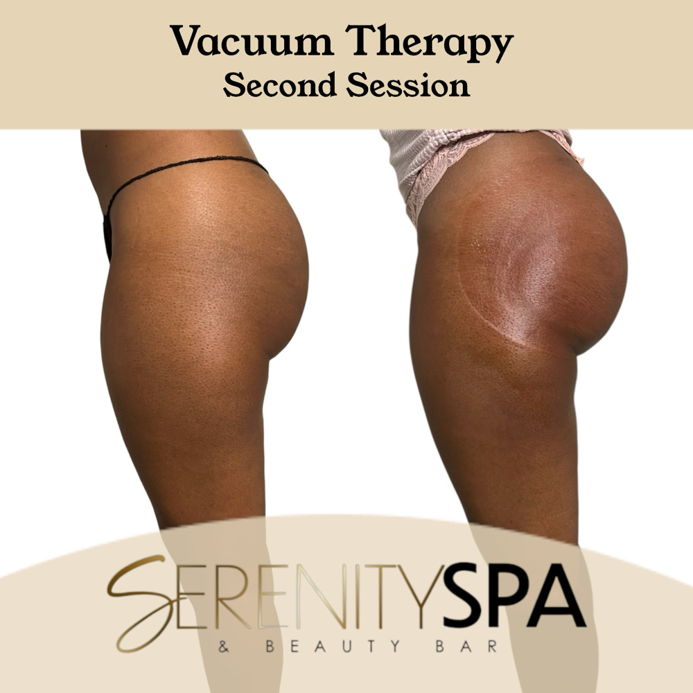 Non-Invasive Vacuum Therapy at Serenity Spa & Beauty Bar in Warwick, RI