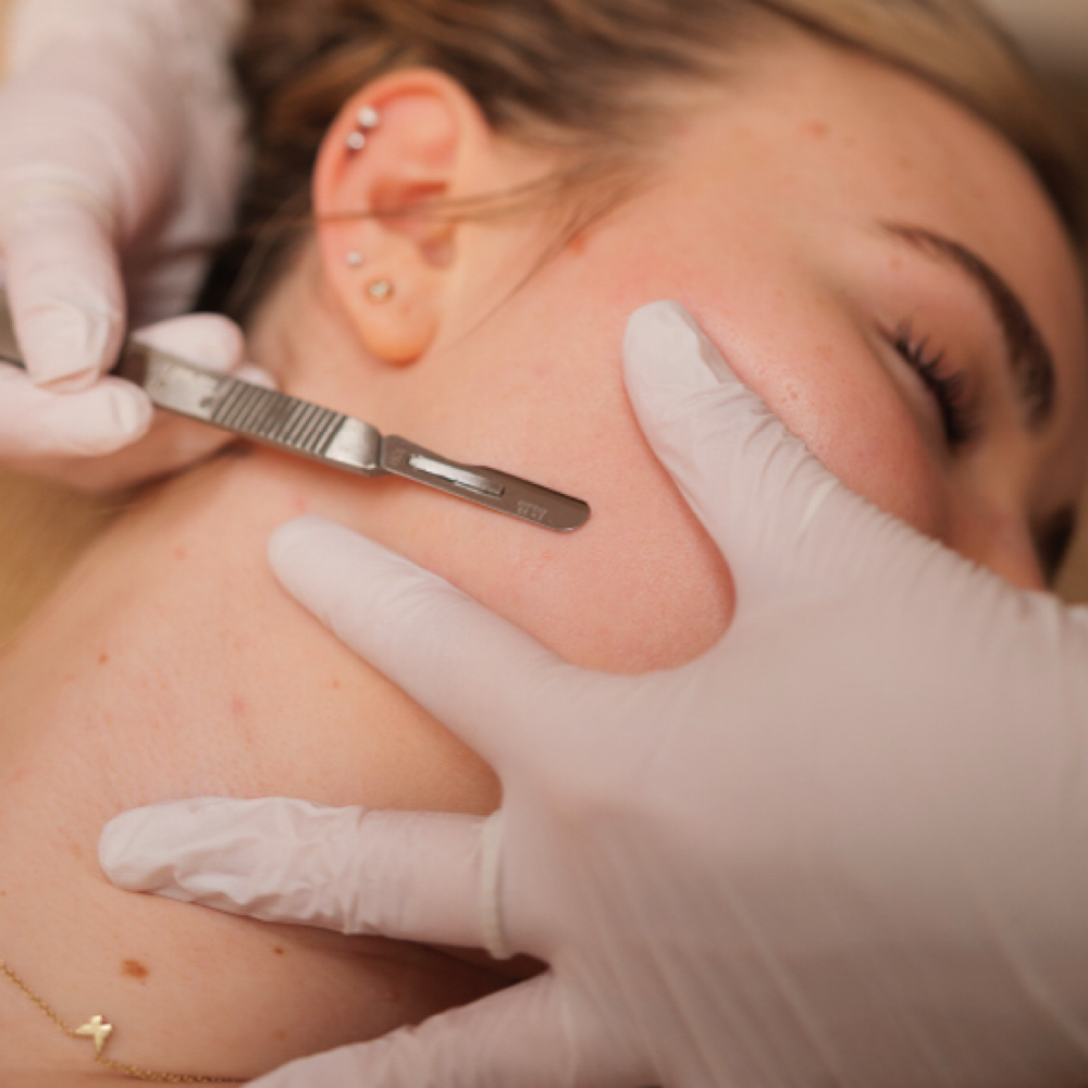 Dermaplaning at Lei Bare Studio in Chatsworth, CA