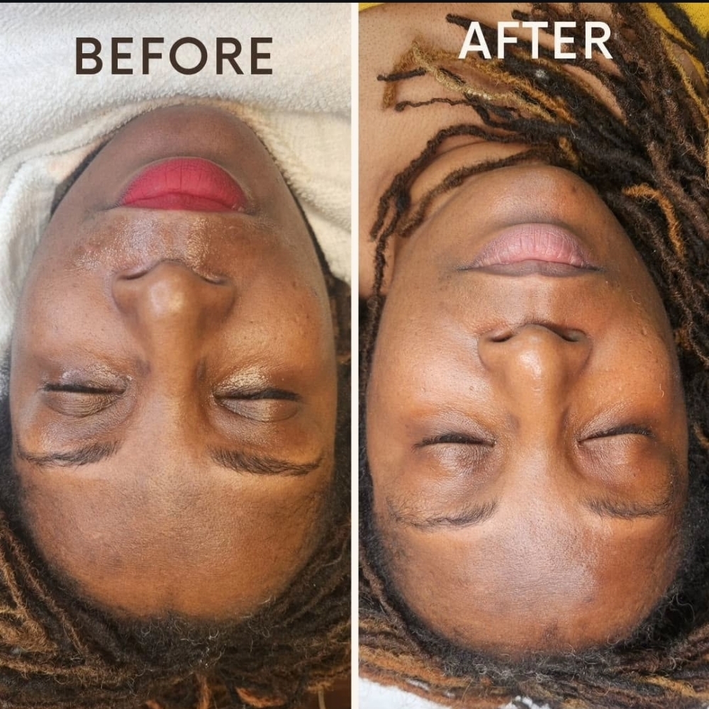 Chemical Peel Consultation