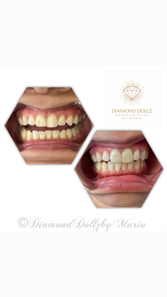 Basic Teeth Whitening Intro. Cost