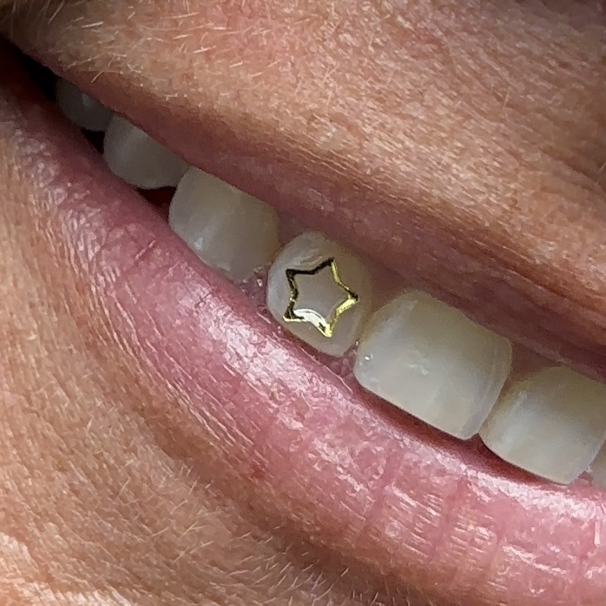 Tooth Gems