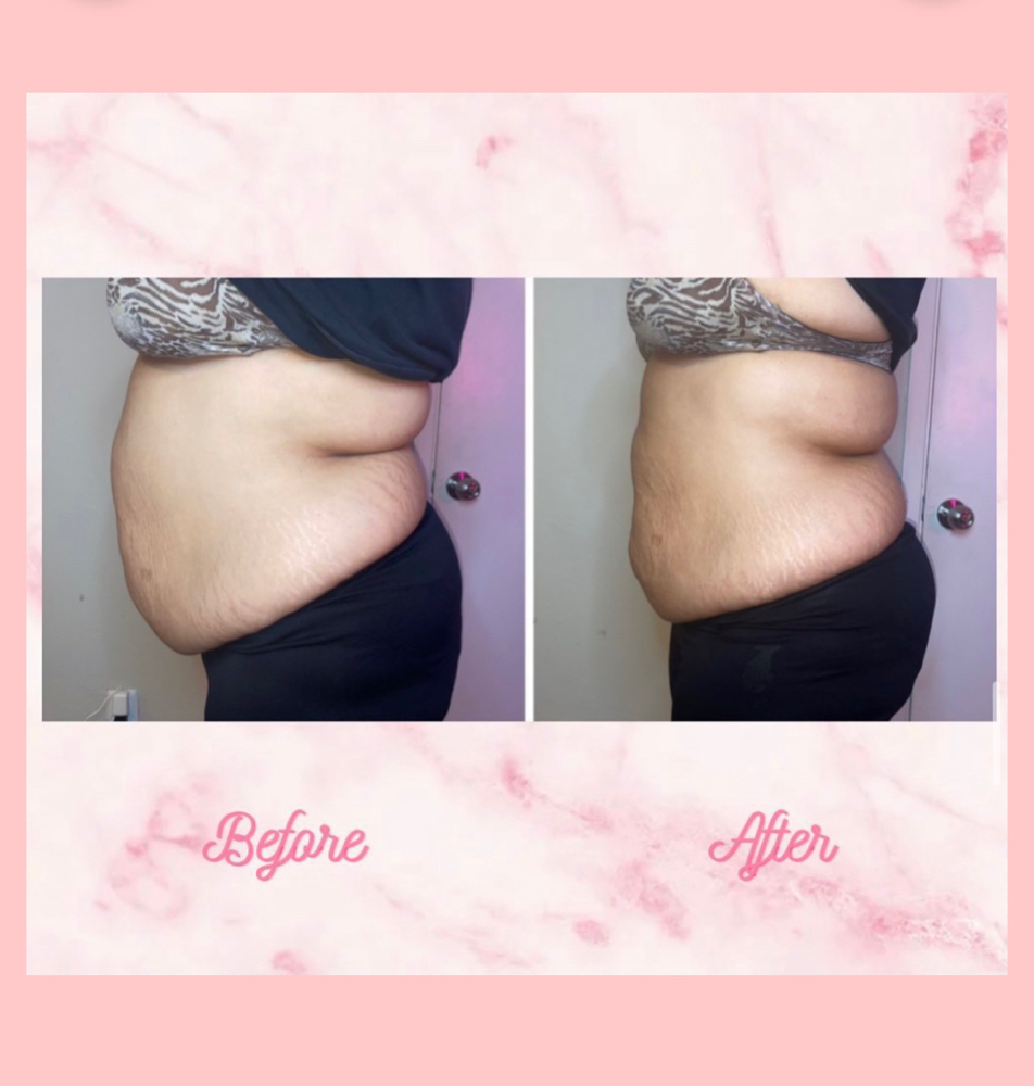 3 Session Package Lipo360 + BBL