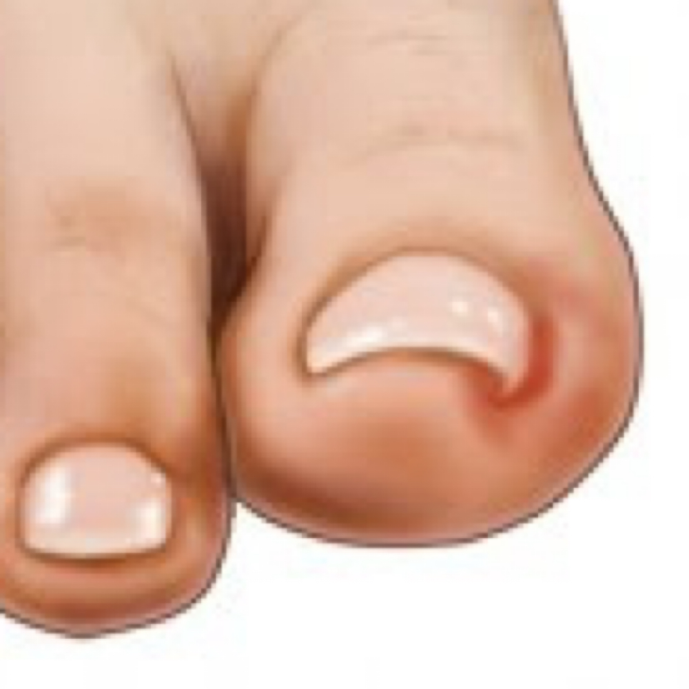 Corrección Uña Lateral at Rut Albornoz/Foot Care37 in Rhode Island, RI