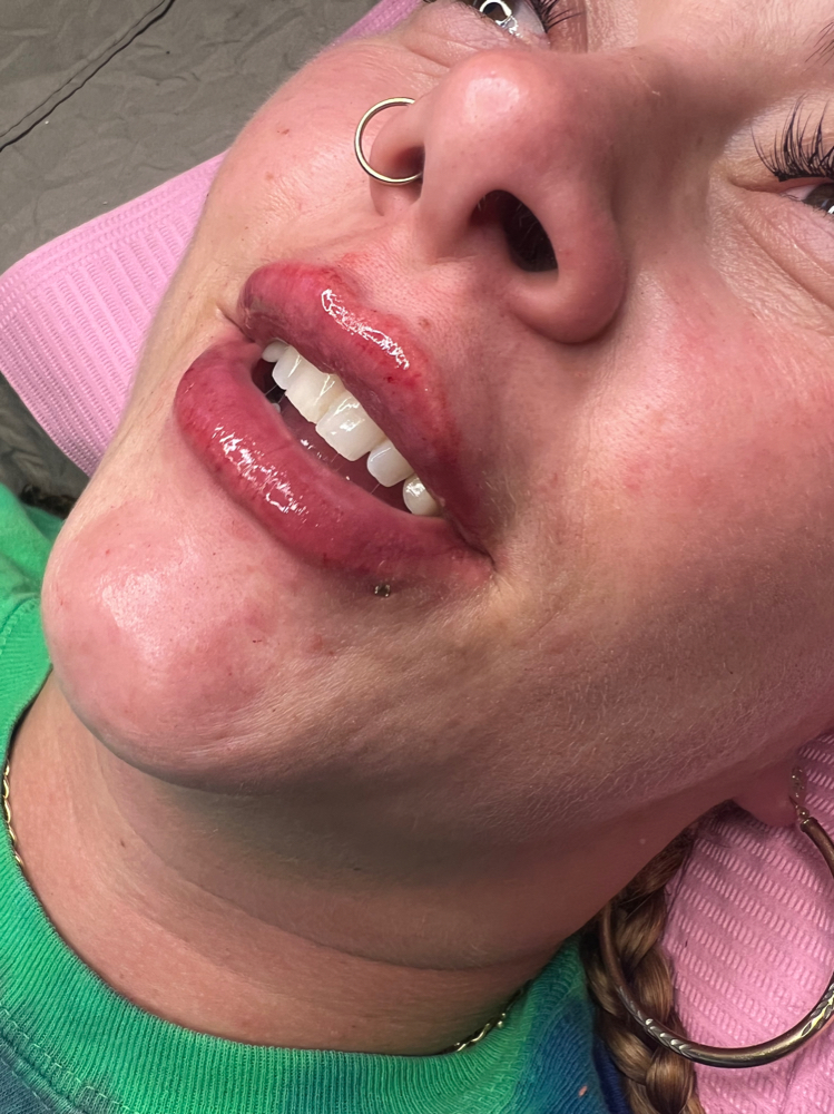 Needless lip Enhancement Sale at Crystallarose Beauty in Erie, PA