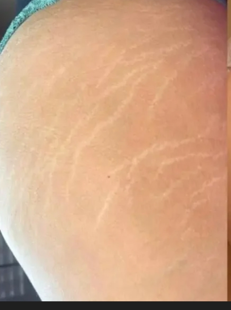 STRETCHMARK CAMOUFLAGE