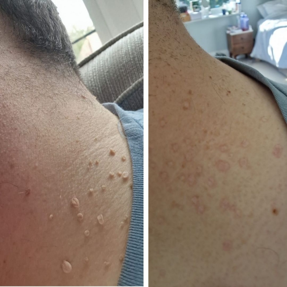 Skin Tag Removal at Glass Face Aesthetics LLC in Fort Stockton, TX