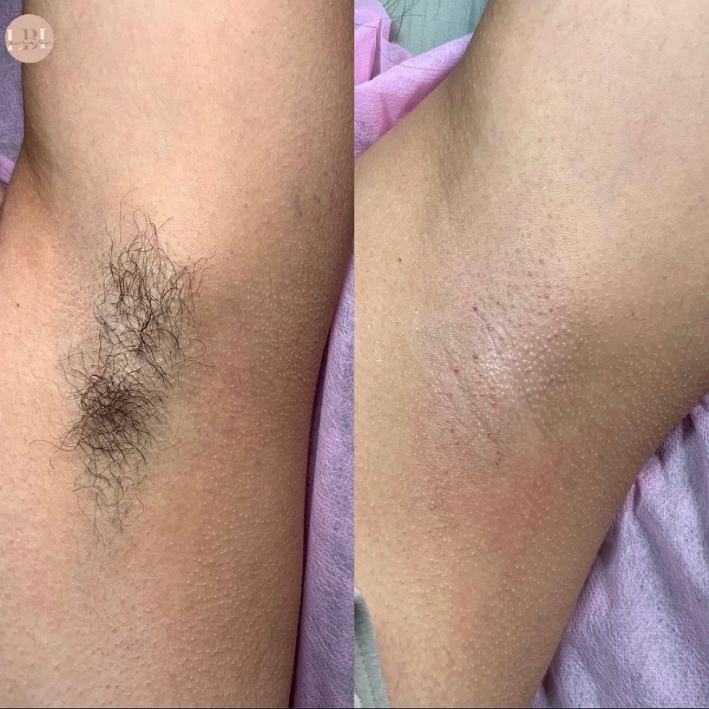 UNDERARMS at The Lash & Beauty Lounge LLC in Pearland, TX