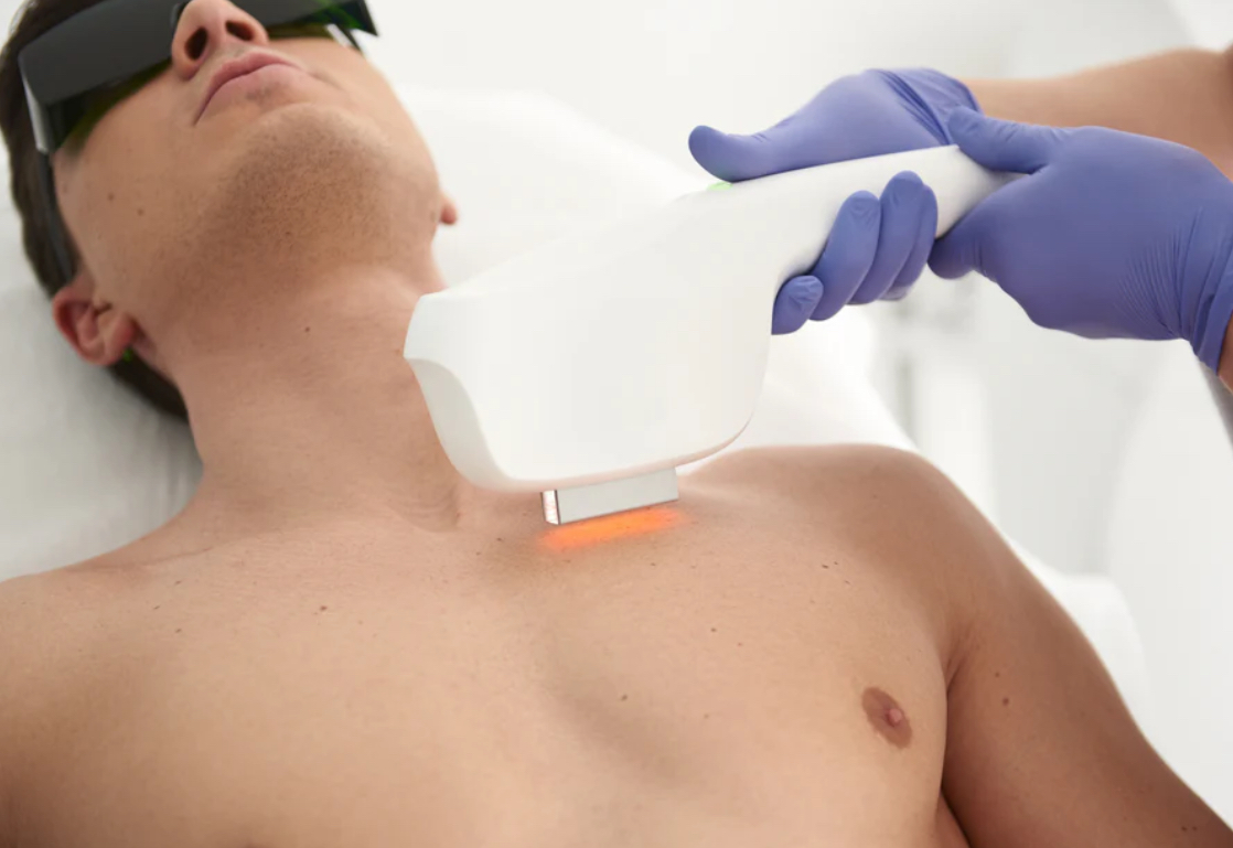 Laser Hair Removal Large Area