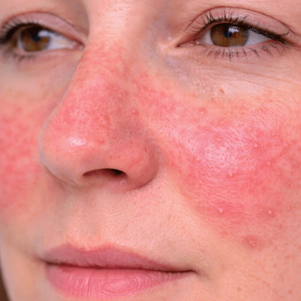 Rosacea & Redness Management at Bliss Beauty Spa in Thomaston, ME