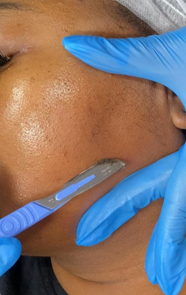 Dermaplaning Treatment
