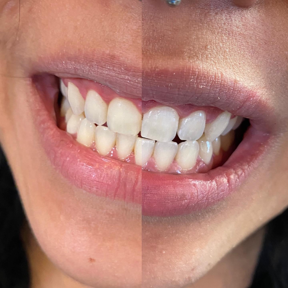 Teeth Whitening Touch Up at Christina’s Cosmetics in Jerome, ID