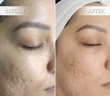 Microneedling package of 6💋