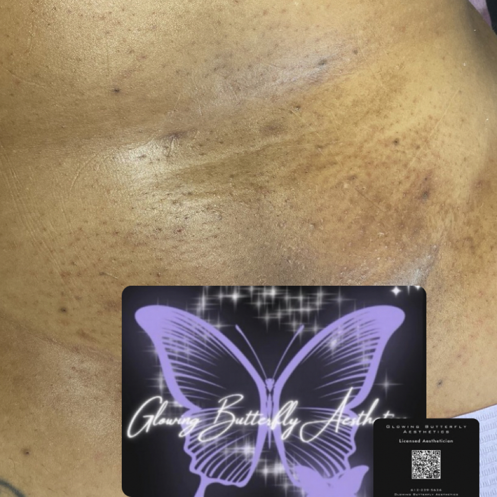 Brazillian Wax at Glowing Butterfly Aesthetics in Minneapolis, MN