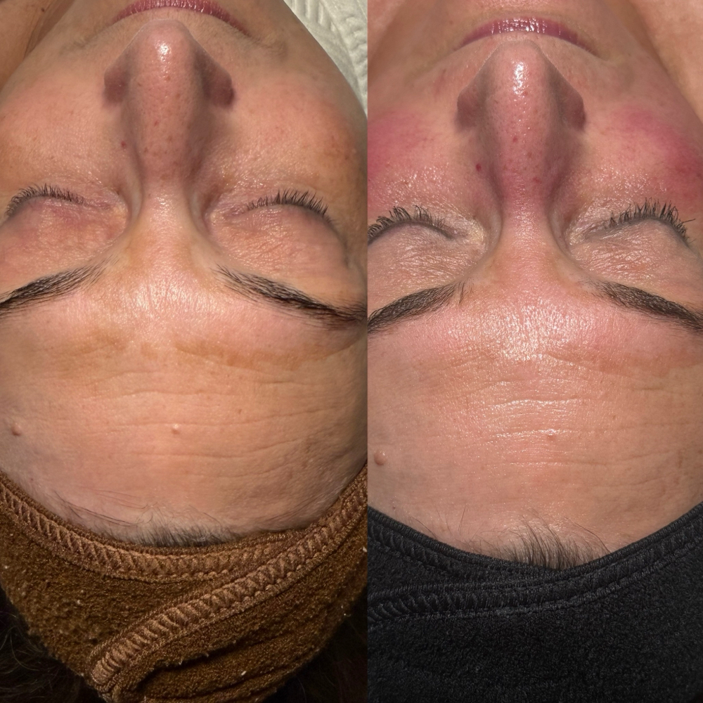 Liquid Microneedling/ Chemical Peel at Taylor’d To You - AWE Skin Studio in Lebanon, TN