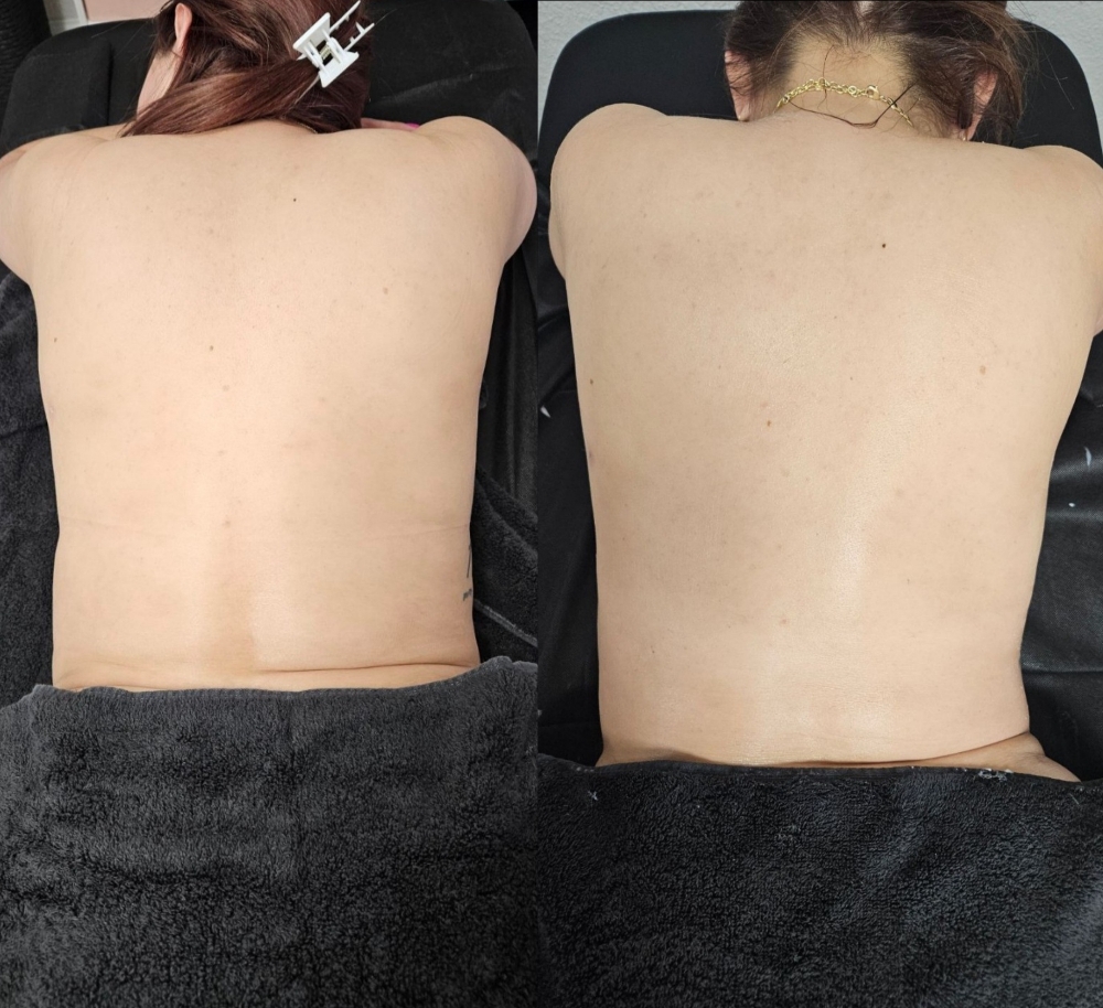 Cavitation Massage