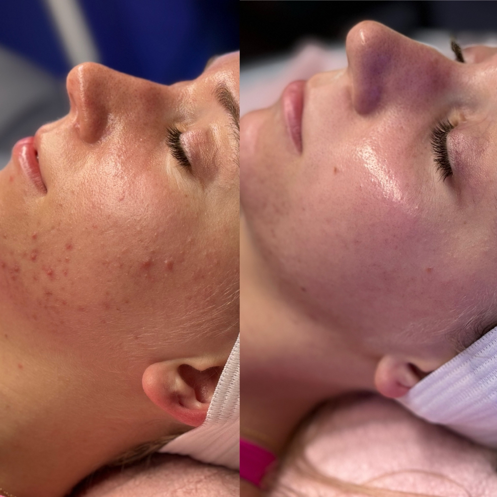 Dermaplane + Acne Peel + LED