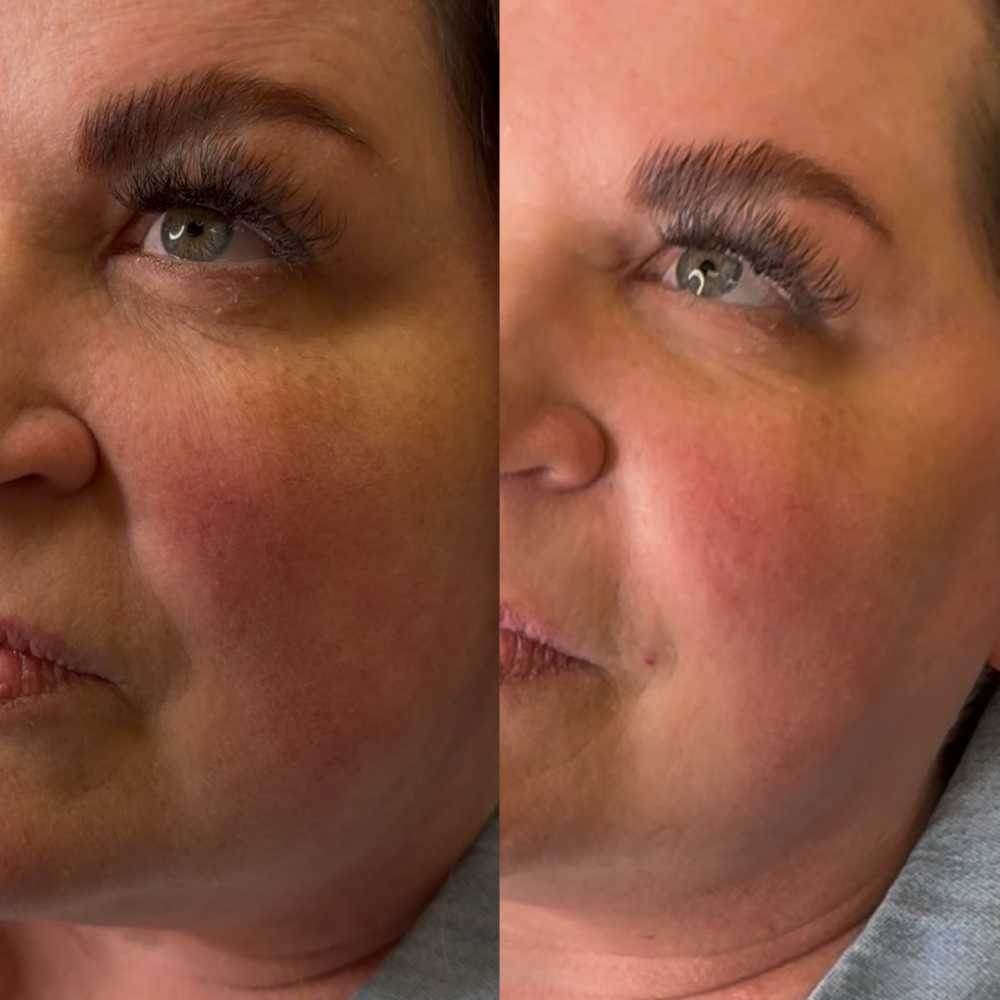 Nasolabial Fold at Dvash Aesthetics in Lubbock, TX