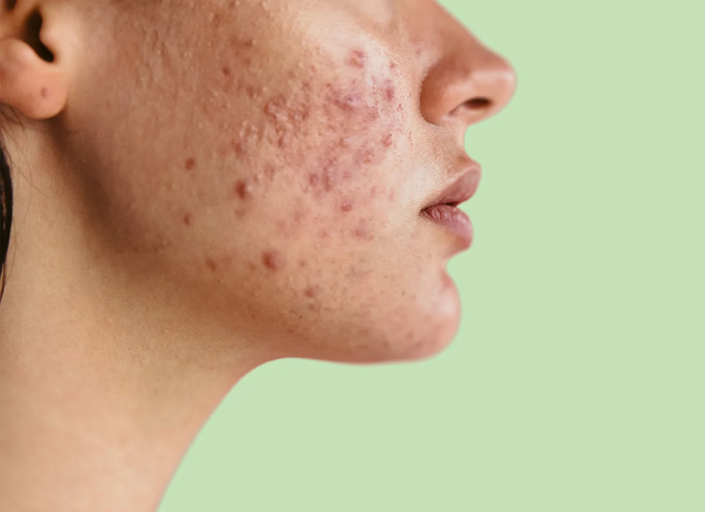 Acne Facial