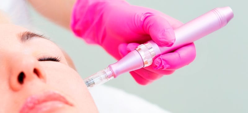 Microneedling